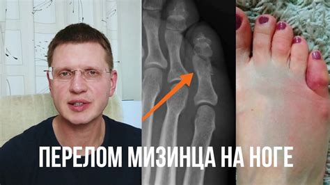 Перелом мизинца на ноге: лечение