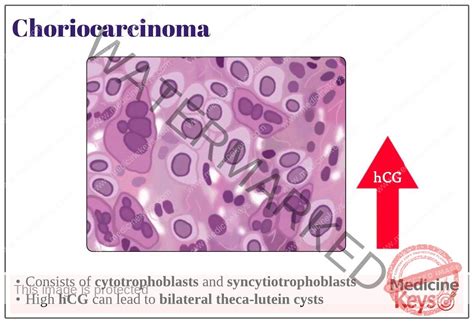 Ovarian Choriocarcinoma Medicine Keys For MRCPs