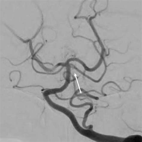 Left Vertebral Digital Subtraction Angiography In Towne Projection