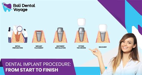 Dental Implant Procedure: What to Expect on the Treatment?