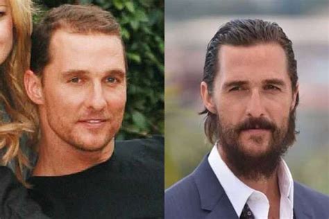 Unbelievable Celebrities Who Have Had Hair Transplants