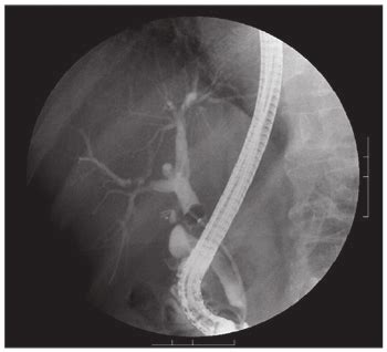 Endoscopic Retrograde Cholangiopancreatography Ercp Image Hospital