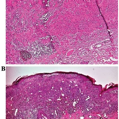 Tumor Infiltrating Lymphocytes A Non Brisk TIL H E X100 B