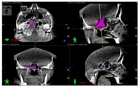 Diagnostics Free Full Text Intraoperative Sphenoid Sinus Volume Measurement As An