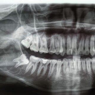 Initial Panoramic Radiograph Showing An Multilocular Radiolucent Large