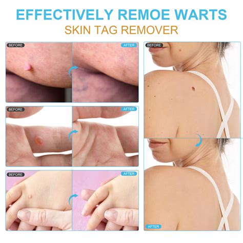 Elaimei Skin Tag Remover Instant Treatment Safe Wart Removal Body Face