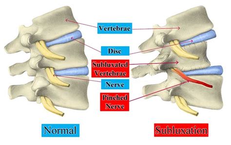 Understanding Spinal Subluxation Henry Chiropractic