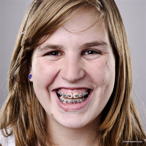 60 Photos of Teenagers with Braces - Robweigner's blog