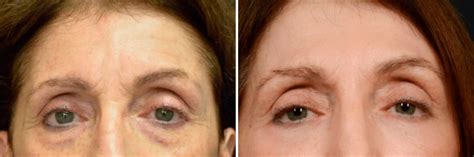 Co2 Fractional Laser Specials Near Me Nj Skin Resurfacing Cost