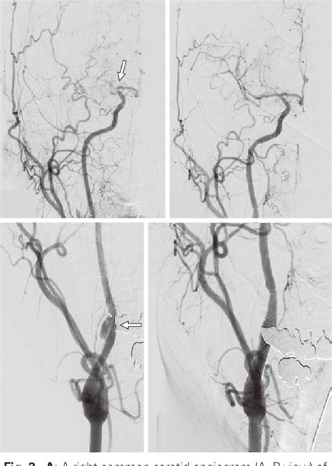 Figure From A Case Of Internal Carotid Artery Dissection Caused By An