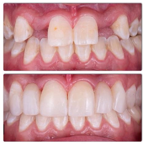 21 dental implant before and after photos – Artofit