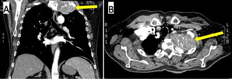 Pancoast Syndrome Due to Metastatic Hepatocellular Carcinoma ...