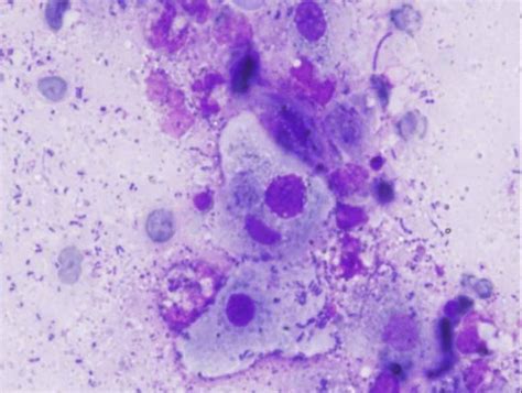 Malignant Transformation Of Donovanosis Granuloma Inguinale In A Hiv