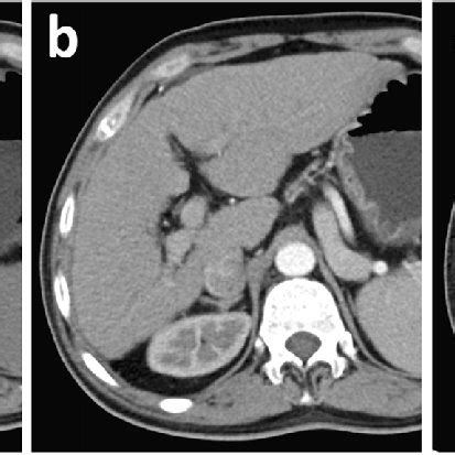 Imaging signs of liver fibrosis | Download Table