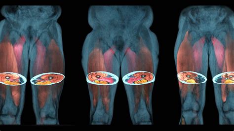 AMRA Medical Medical Imaging And Body Composition Analysis