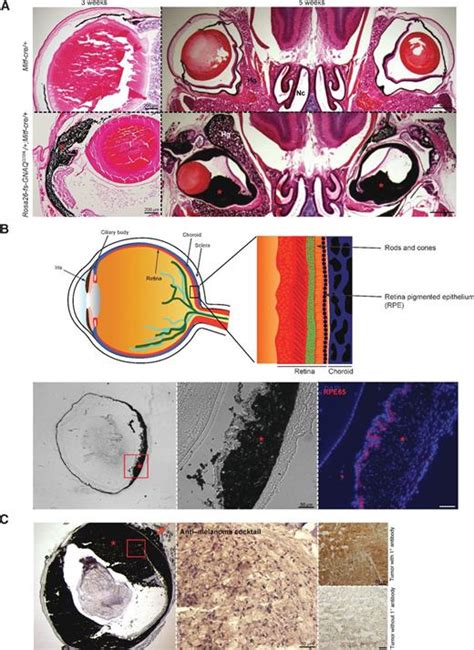 Oncogenic G Protein Gnaq Induces Uveal Melanoma And Intravasation In