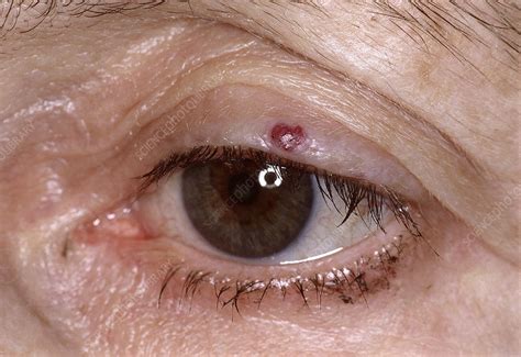 Eyelid Hemangioma