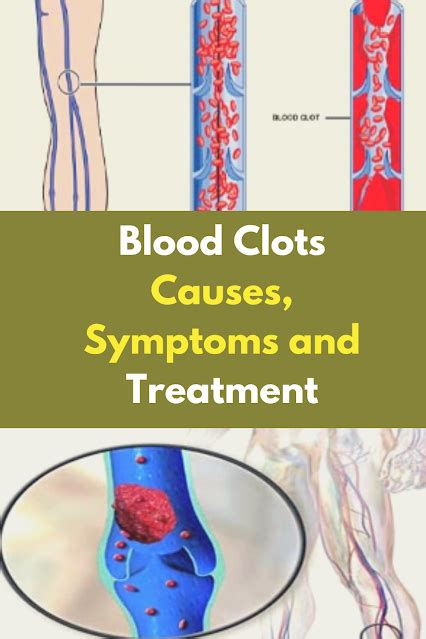 Blood Clots Causes, Symptoms and Treatment