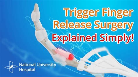 Trigger Finger Release Surgery Explained YouTube