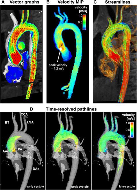 Examples Of 4D Flow CMR Visualization Techniques All Examples Are