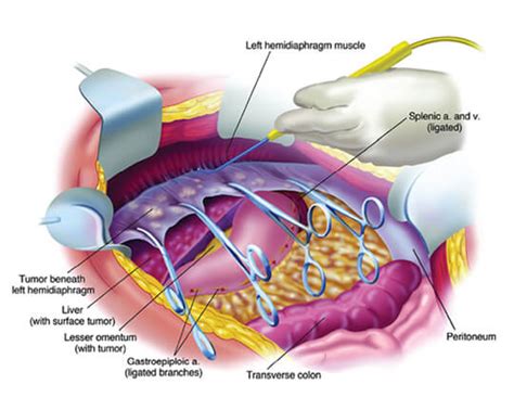 Cirug A De La Carcinomatosis Peritoneal Miss Cirug A Laparosc Pica