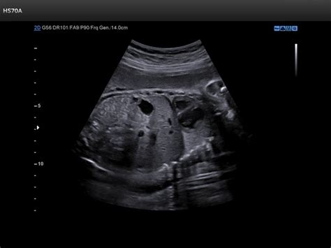 Ultrasound Images Fetus Abdomen B Mode Echogramm 723