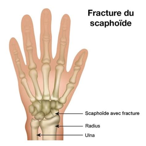 Fracture du scaphoïde Chirurgien de l épaule et de la main