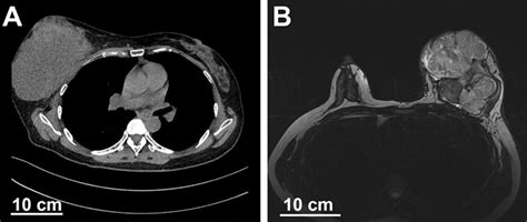 Preoperative High Resolution Computed Tomography Hrct And Magnetic