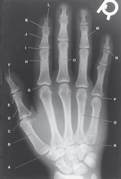 Ch Pa Radiograph Of Right Hand Diagram Quizlet