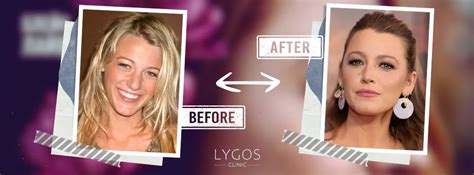 blake lively burun estetigi unlulerde burun estetigi