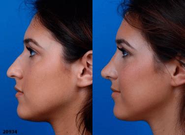 New York Rhinoplasty Nose Job Expert Dr Philip Miller