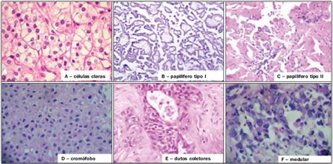 Radiologia Brasileira Carcinoma de células renais classificação