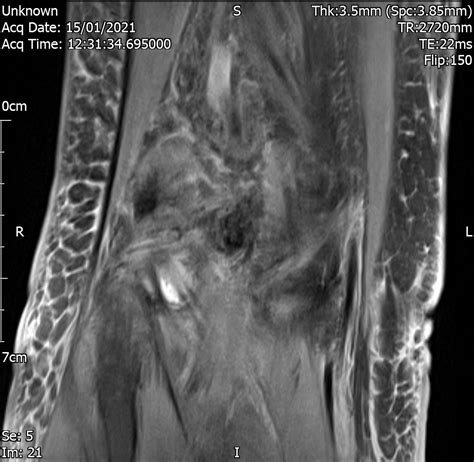 Knee Synovitis | Cases - Home