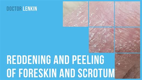 Reddening And Peeling Of Foreskin And Scrotum Youtube