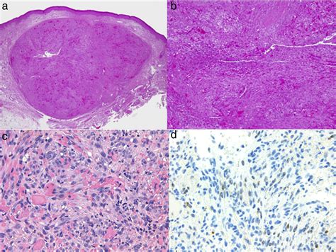 Kaposi Sarcoma And Cutaneous Angiosarcoma Guidelines For Diagnosis And