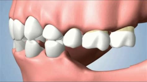 Several Teeth Loss Consequences Youtube