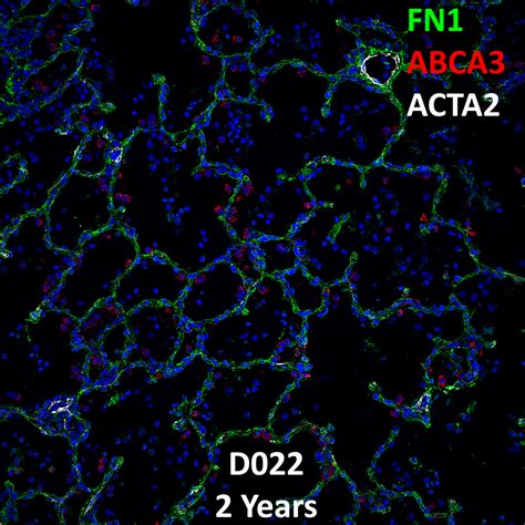 Year Old Human Lung Immunofluorescence And Confocal Imaging Donor