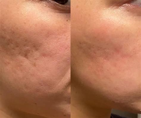 Acne Scars