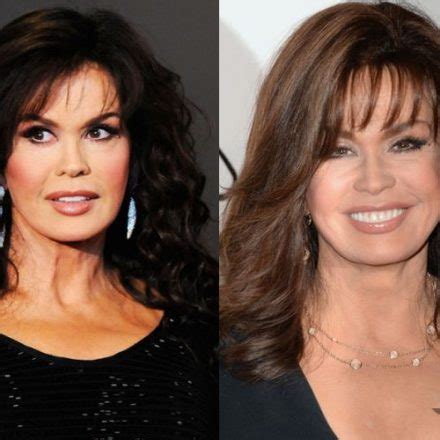 Marie Osmond Plastic Surgery: is it really just Botox? - Plastic ...