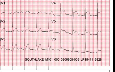 Dr Smiths Ecg Blog Is It Early Repol Pericarditis Or Anterior Stemi