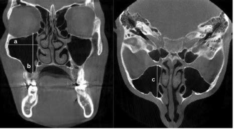 Figure 1 From The Effect Of Anatomical Variations Of The Sinonasal