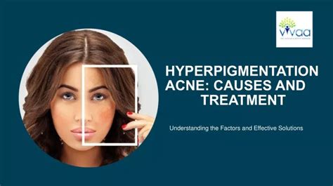 Ppt Acne Hyperpigmentation Causes And Solutions Powerpoint