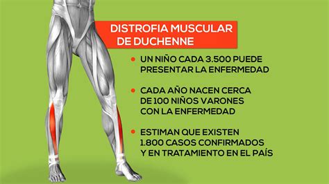 Enfermedad De Duchenne C Mo Es Vivir Toda La Vida Con M Sculos D Biles