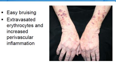 S3 Guideline For Actinic Keratosis And Cutaneous Squamous 47 Off