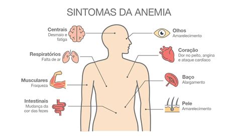 Anemia Ferrop Nica