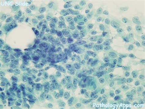 Pleomorphic Adenoma Salivary Gland Cytology