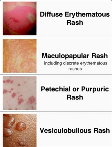 8 Common Types Of Rashes Skin Beauty Hair Types Of Rashes Images