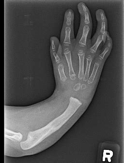 Pediatric Hand Conditions | Pediatric Orthopedics of SWFL