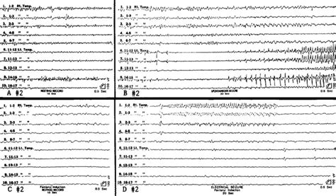 Fentanyl Induced Electrocorticographic Seizures In Patients With