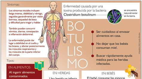 Botulismo La Importancia De Identificar Los Primeros S Ntomas